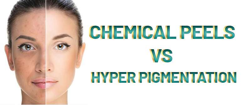 Chemical Peel For Acne And Hyperpigmentation In Islamabad R M C