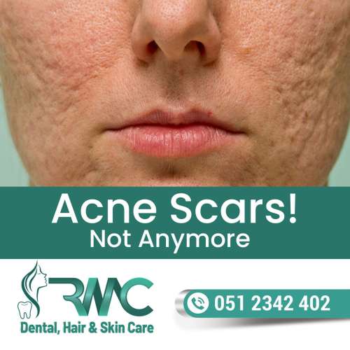 Laser Treatment For Acne Scars in Islamabad  R M C