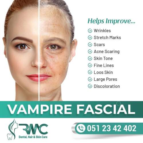 Vampire Facial Treatment in Islamabad - Vampire Facial In Islamabad - Facial-RMC