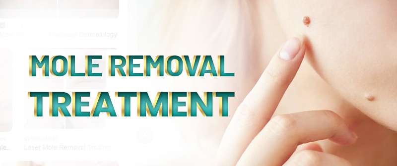 Laser Mole Removal in Islamabad  Rehman Medical Center