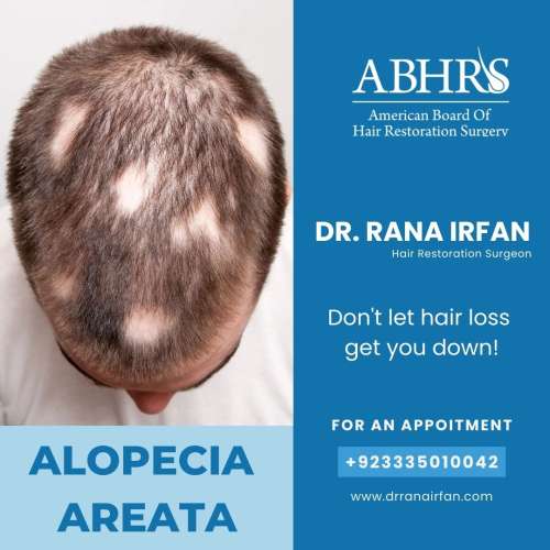 Hair restoration services in Pakistan