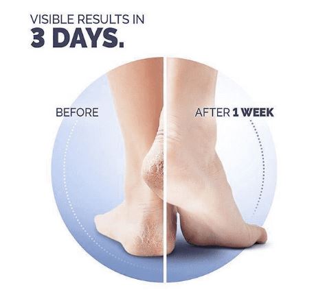 Anti Crack Pain Reliever Heel Protector Nourishment Solution Reusable