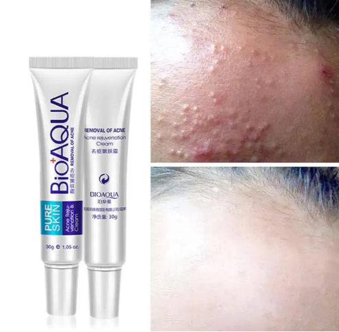 BIOAQUA Pure Skin Face Care Acne Treatment Scar Removal Cream Data Darbar Road,